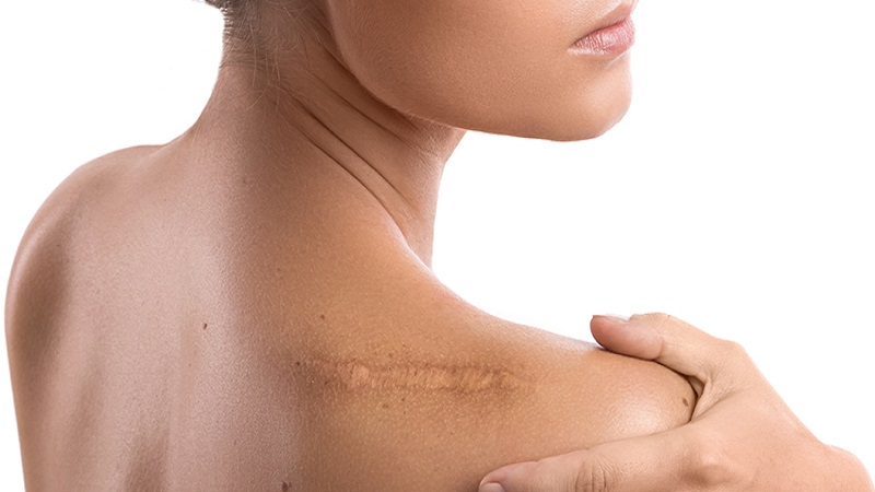 جراح پلاستیک اصفهان انواع عارضه جای زخم