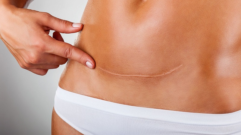 جراح پلاستیک اصفهان جای زخم چطور به وجود می آید ؟