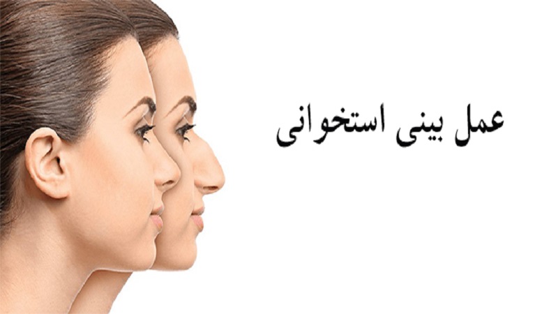 جراح بینی اصفهان جراحی بینی استخوانی