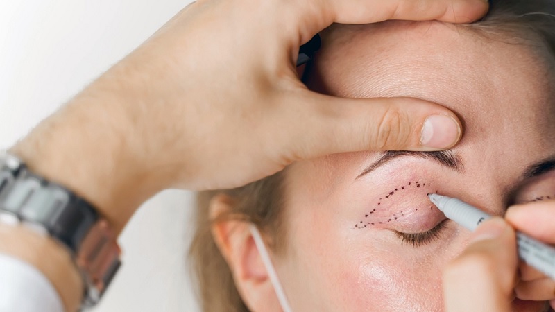 خطرات بالقوه در جراحی پلک و راهکارهای پیشگیری از آن‌ها | جراح بینی اصفهان | دکتر علی علوی راد