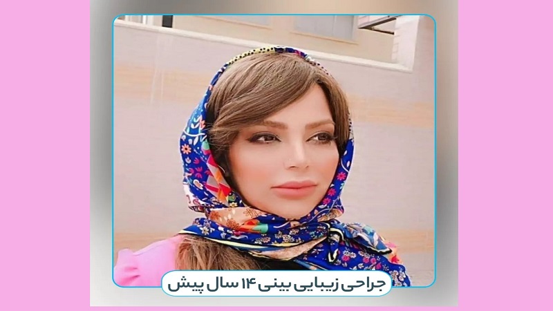 جراح بینی اصفهان | دکتر علی علوی راد | فوق تخصص جراحی پلاستیک اصفهان | رضایت از جراحی بینی پس از 14 سال