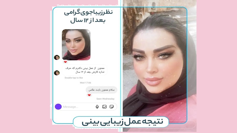 جراح بینی اصفهان | دکتر علی علوی راد | فوق تخصص جراحی پلاستیک اصفهان | نتیجه عمل زیبایی بینی زیباجوی گرامی بعد از ۱۲ سال