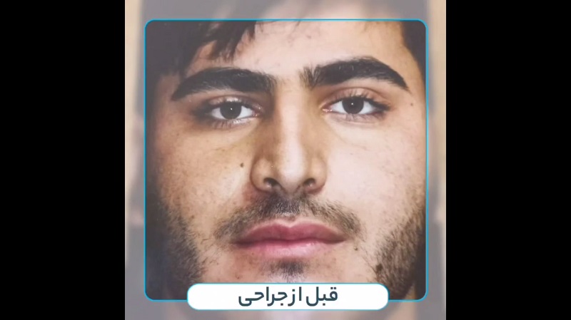 جراح بینی اصفهان | دکتر علی علوی راد | فوق تخصص جراحی پلاستیک اصفهان | نمونه جراحی زیبایی بینی