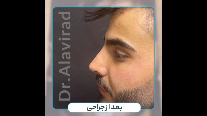 جراح بینی اصفهان | دکتر علی علوی راد | فوق تخصص جراحی پلاستیک اصفهان | نمونه جراحی زیبایی بینی