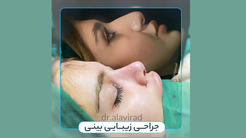 جراح بینی اصفهان | دکتر علی علوی راد | فوق تخصص جراحی پلاستیک اصفهان | نمونه عمل بلافاصله بعداز جراحی زیبایی بینی