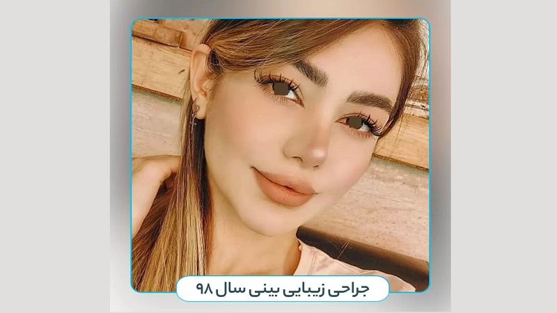 جراح بینی اصفهان | دکتر علی علوی راد | فوق تخصص جراحی پلاستیک اصفهان | رضایت زیباجوی گرامی از نتیجه جراحی زیبایی بینی سال 1398
