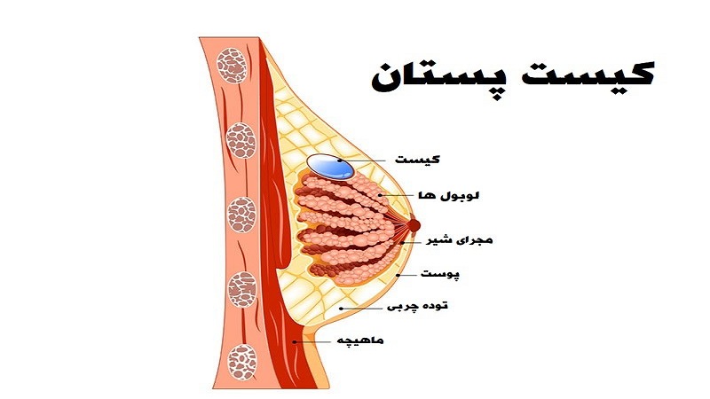 علائم و روش های درمان کیست پستان