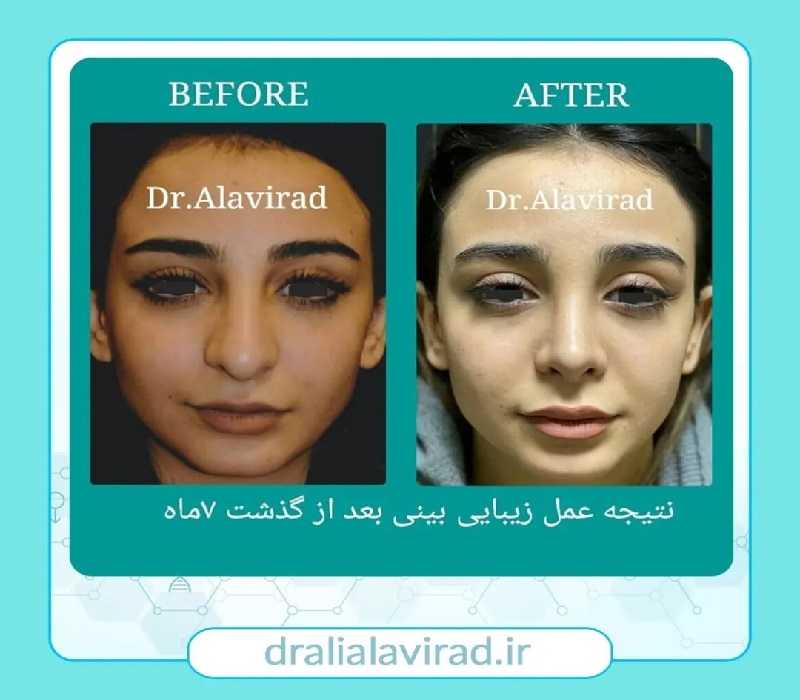 جراح بینی اصفهان | قبل و بعد از جراحی بینی