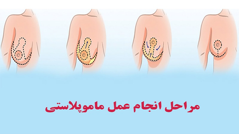 ماموپلاستی کاهشی|هترین جراح بینی اصفهان، بهترین جراح پلاستیک اصفهان، بهترین فوق تخصص جراحی پلاستیک اصفهان، بهترین متخصص جراحی پلاستیک، بهترین متخصص جراحی پلاستیک در اصفهان، بهترین متخصص زیبایی، جراح بینی اصفهان، جراح پلاستیک اصفهان، دکتر علی علوی راد| فوق تخصص جراحی پلاستیک اصفهان|متخصص جراح زیبایی بینی اصفهان