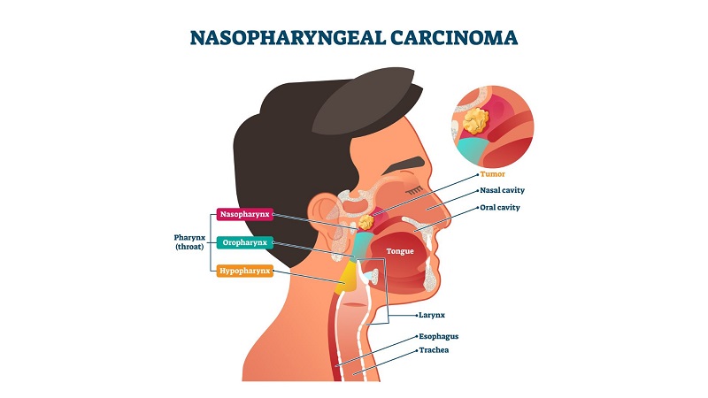انواع مختلف تومور نازوفارنکس | جراح بینی اصفهان | دکتر علی علوی راد