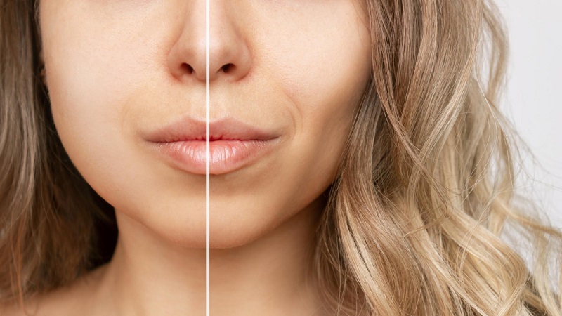 دستیابی به چهره‌ای لاغرتر و جذاب‌تر با بوکال فت | جراح بینی اصفهان | دکتر علی علوی راد