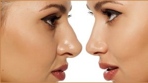 مقایسه جراحی بینی گوشتی با جراحی بینی استخوانی | جراح بینی اصفهان