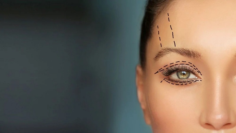 نکات مراقبتی مهم درباره عمل بلفاروپلاستی | جراح بینی اصفهان | دکتر علی علوی راد