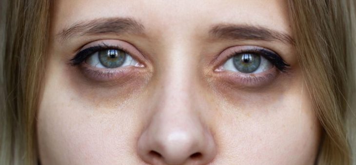 پیشگیری از بروز کبودی چشم‌ها بعد از عمل بینی